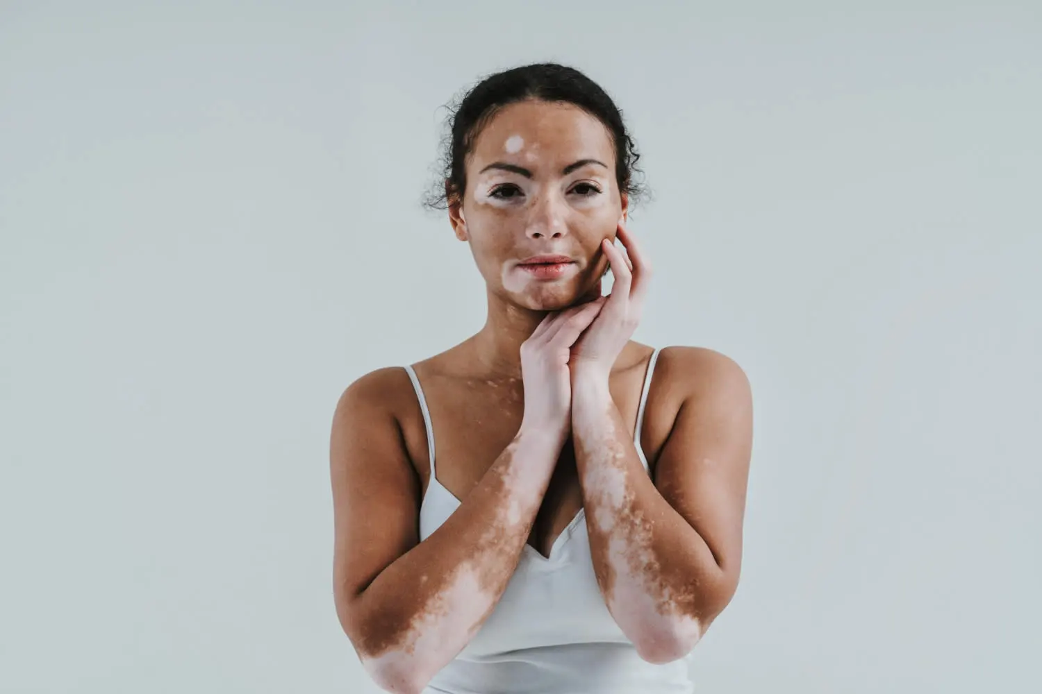 woman-with-vitiligo