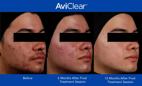 AviClear-Before-and-after-treatment-2