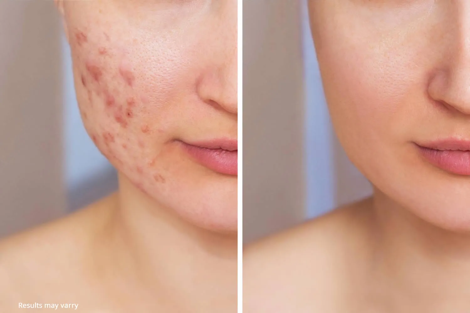 face-before-after-acne-treatment-aviclear-laser